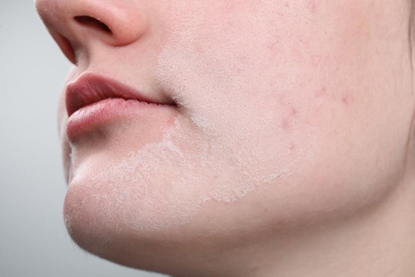Mujer con piel seca en su rostro contra un fondo claro.